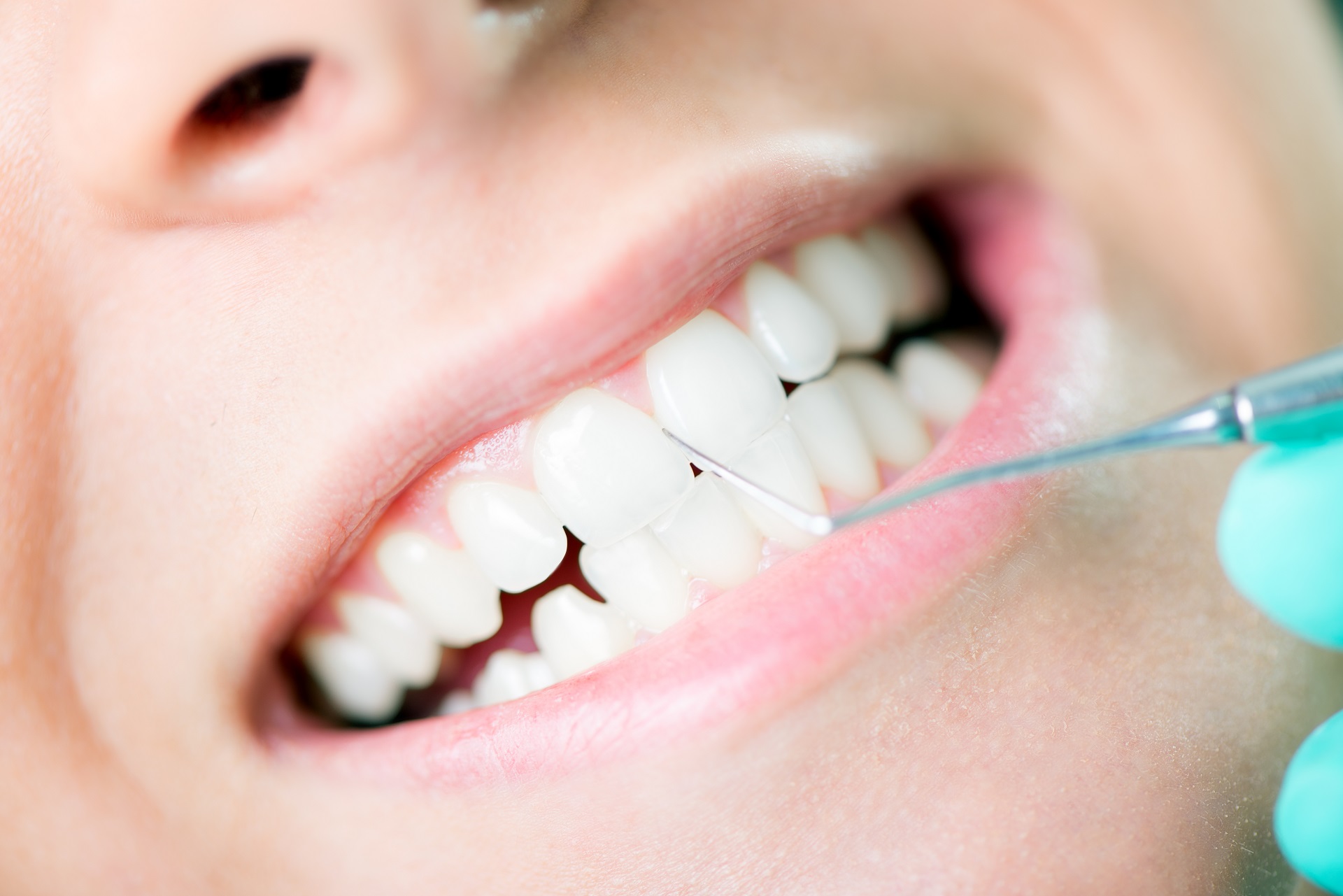 Teeth Cleaning and Polishing in Aligarh Gentle Dental Home